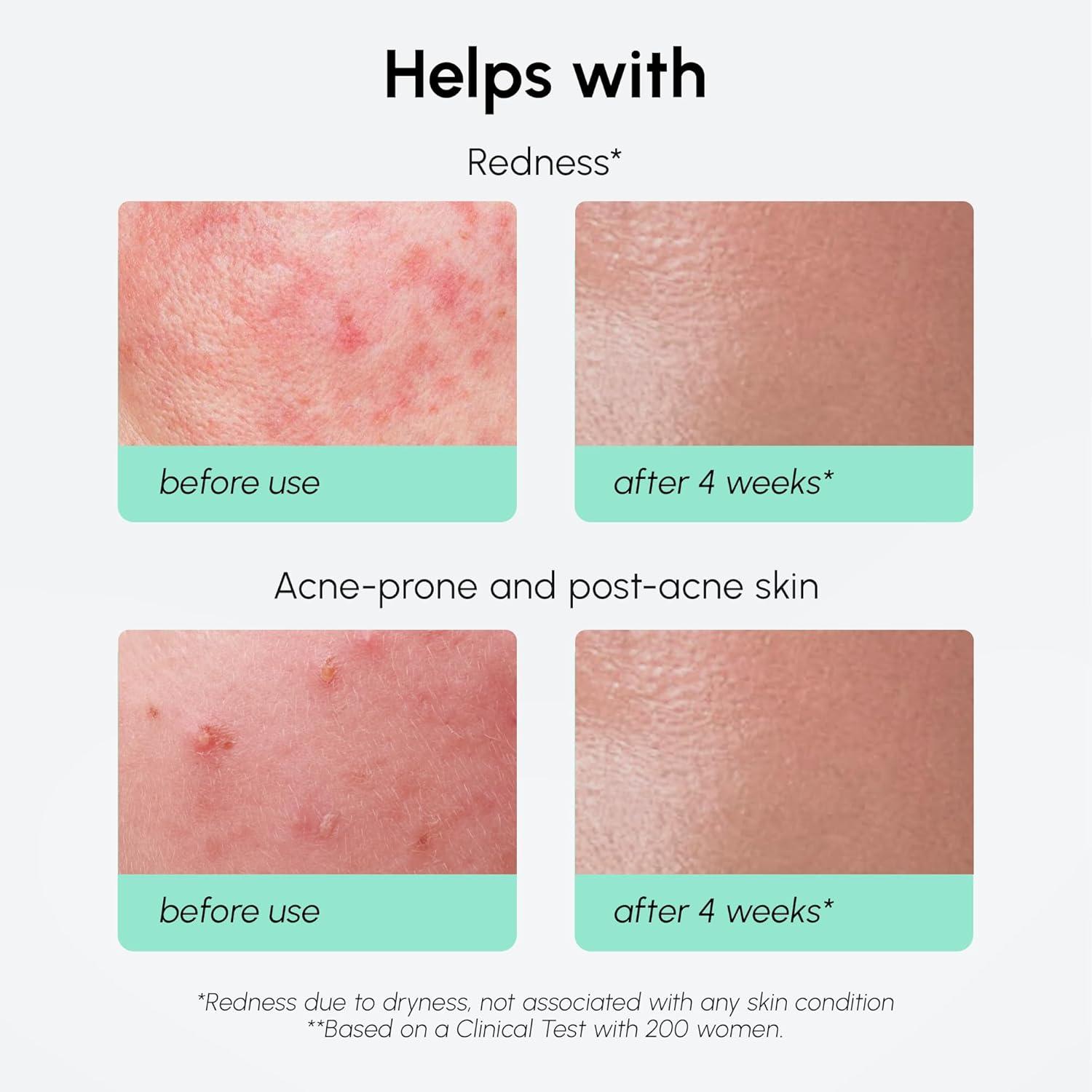 imageMAREE 20 Tranexamic Acid Serum Complex with Niacinamide amp Vitamin C Serum for Face amp Body Dark Spot Corrector Age Spots Hyperpigmentation Care Remover Brightening Acido Tranexamico para ManchasAzelaic Acid Face Serum