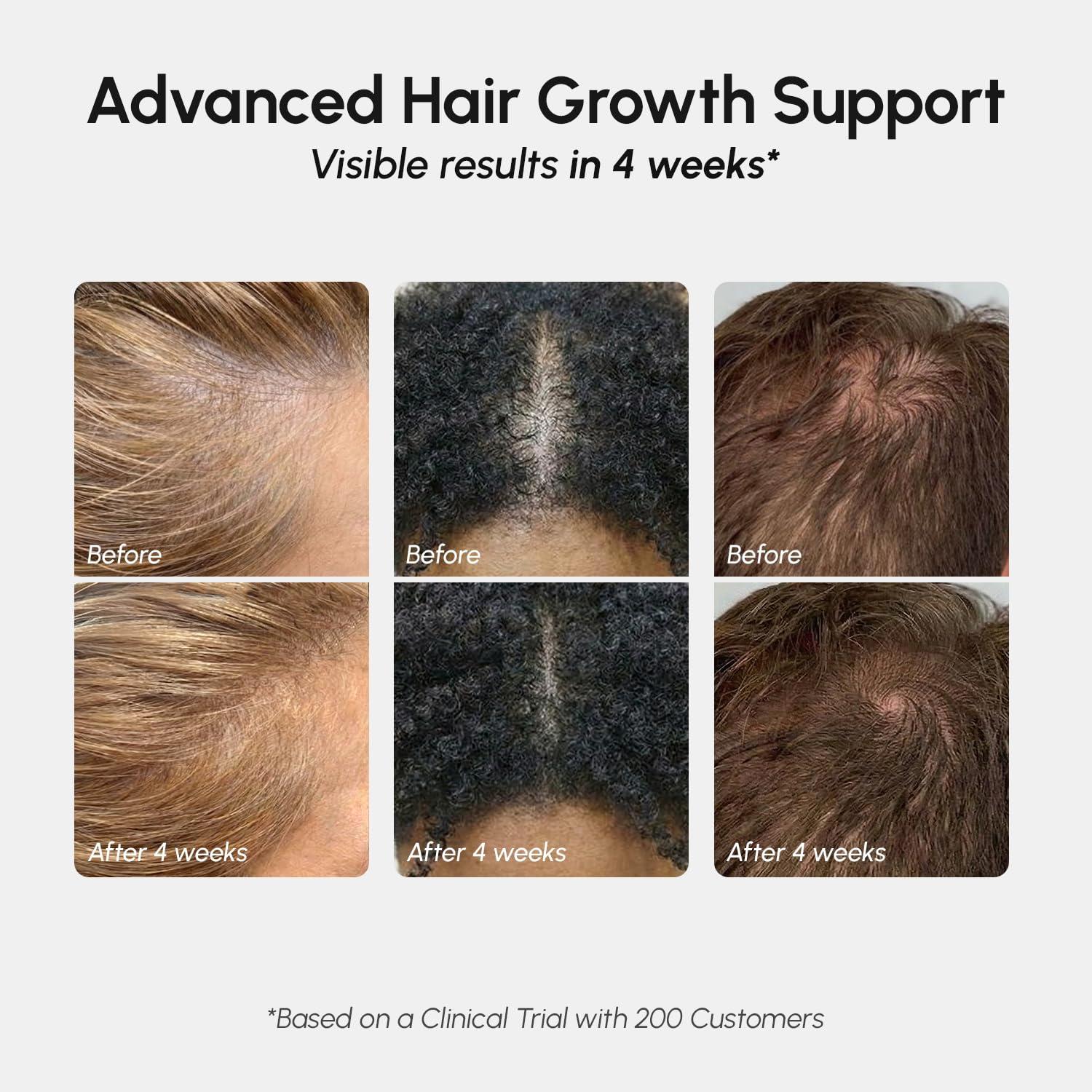 imageMAREE Hair Growth Spray Caffeine Batana Castor amp Rosemary Oil for Hair Growth Products for Women amp Men Hair Oils for Hair Growth Hair Thickening Spray for Roots Hair Regrowth amp Scalp CareHair Growth Spray
