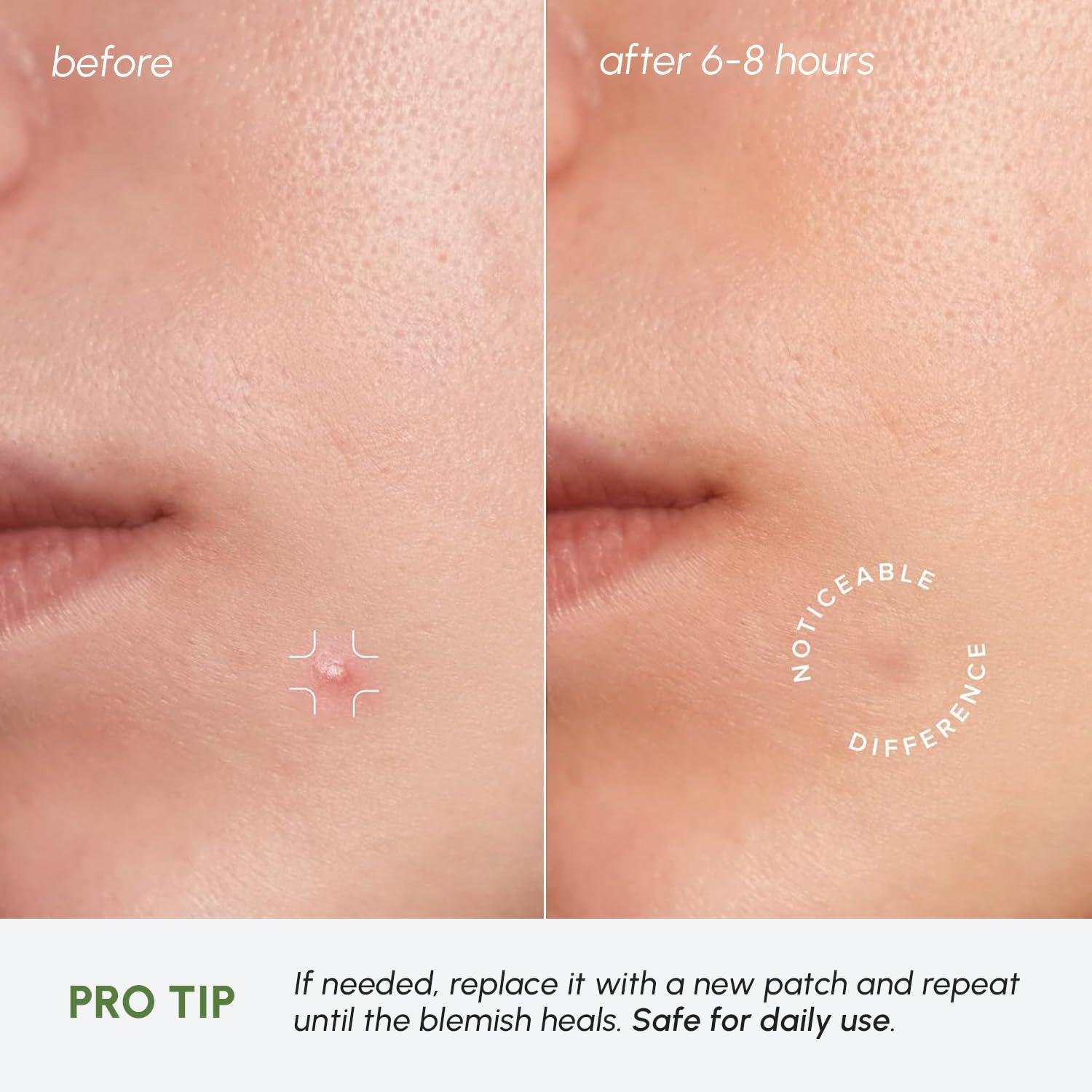 imageMAREE Invisible Pimple Patches Clear Pimple Patches for Face Hydrocolloid Acne Patches Anti Blemish Zit Stickers for Face Parches Para Acne Pinple Zit Patches Pimple Stickers 72 DotsClear