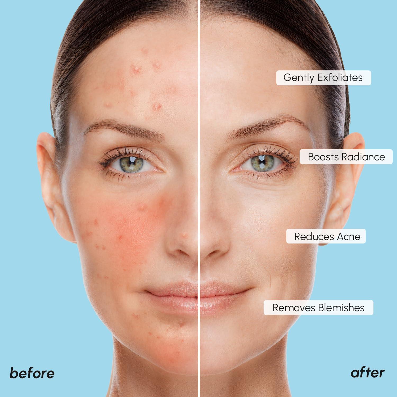 imageMAREE Glycolic Acid Pads Toner Pads for Face Cleansing Exfoliating Pad with Tea Tree Oil Salicylic Acid amp Vitamins E B3 B5 Acne Clearing Skin Pore Resurfacing amp Radiance Device 80 CountGlycolic Pads 2 Pack