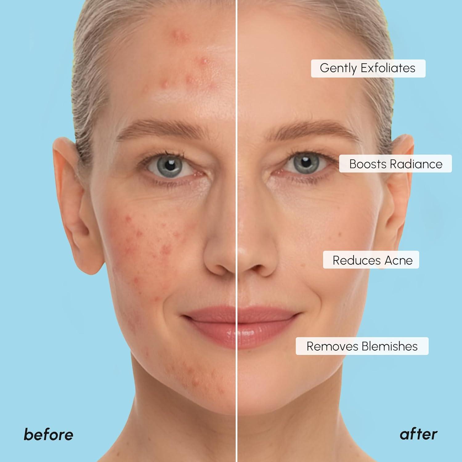 imageMAREE Glycolic Acid Pads Toner Pads for Face Cleansing Exfoliating Pad with Tea Tree Oil Salicylic Acid amp Vitamins E B3 B5 Acne Clearing Skin Pore Resurfacing amp Radiance Device 80 CountGlycolic Pads 200 Pcs