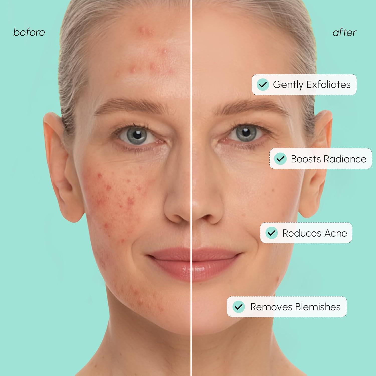 imageMAREE Glycolic Acid Pads Toner Pads for Face Cleansing Exfoliating Pad with Tea Tree Oil Salicylic Acid amp Vitamins E B3 B5 Acne Clearing Skin Pore Resurfacing amp Radiance Device 80 CountAzelaic Pads